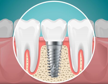 dental Implants